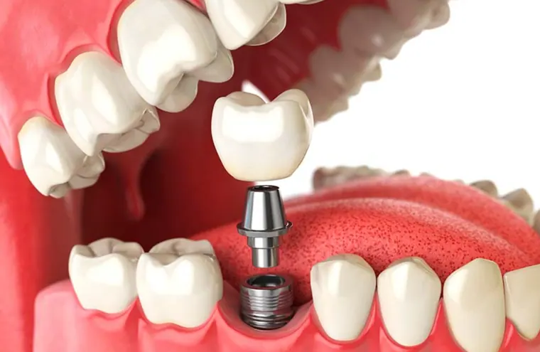 Modelo dental con implante y corona protésica