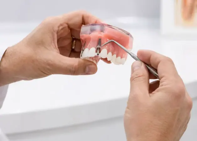 Modelo dental mostrando un implante